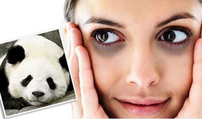 Mắt bị quầng thâm khiến chị em luôn mệt mỏi và mất thẩm mỹ